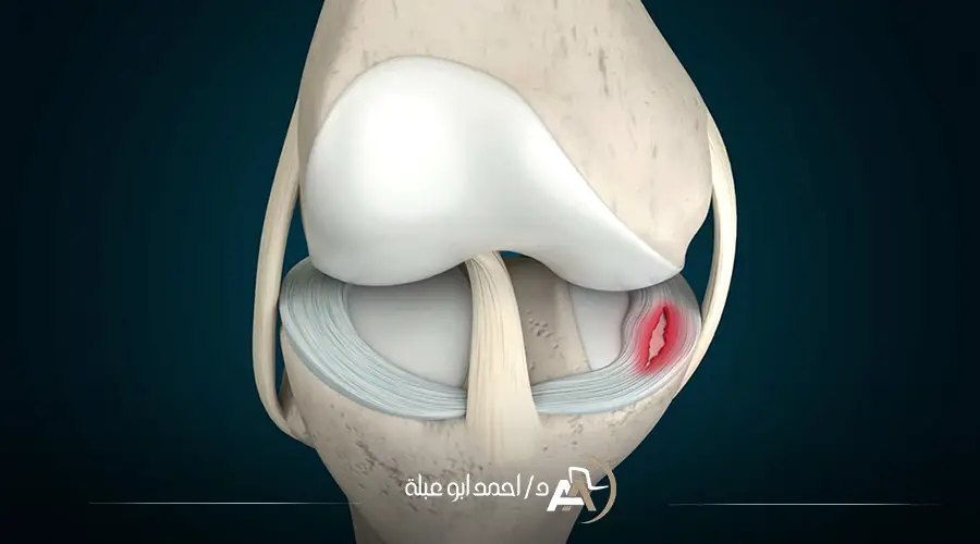 تكلفة عملية الغضروف الهلالي في مصر