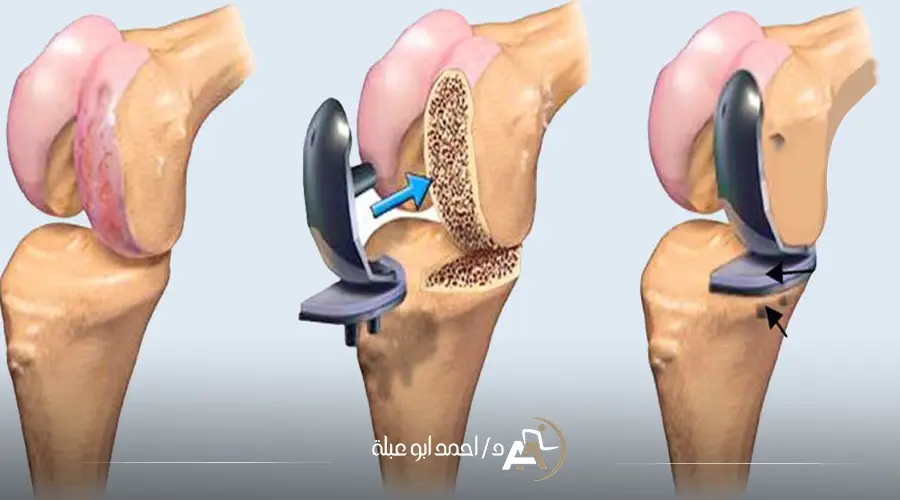 سعر عملية تغيير مفصل الركبة
