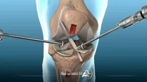 عملية الرباط الصليبي بالمنظار