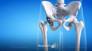 عملية تغيير مفصل الفخذ