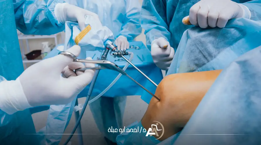 عملية قطع غضروف الركبة بالمنظار