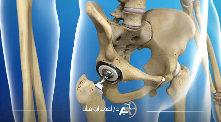 اسعار المفاصل الصناعية للفخذ (1)